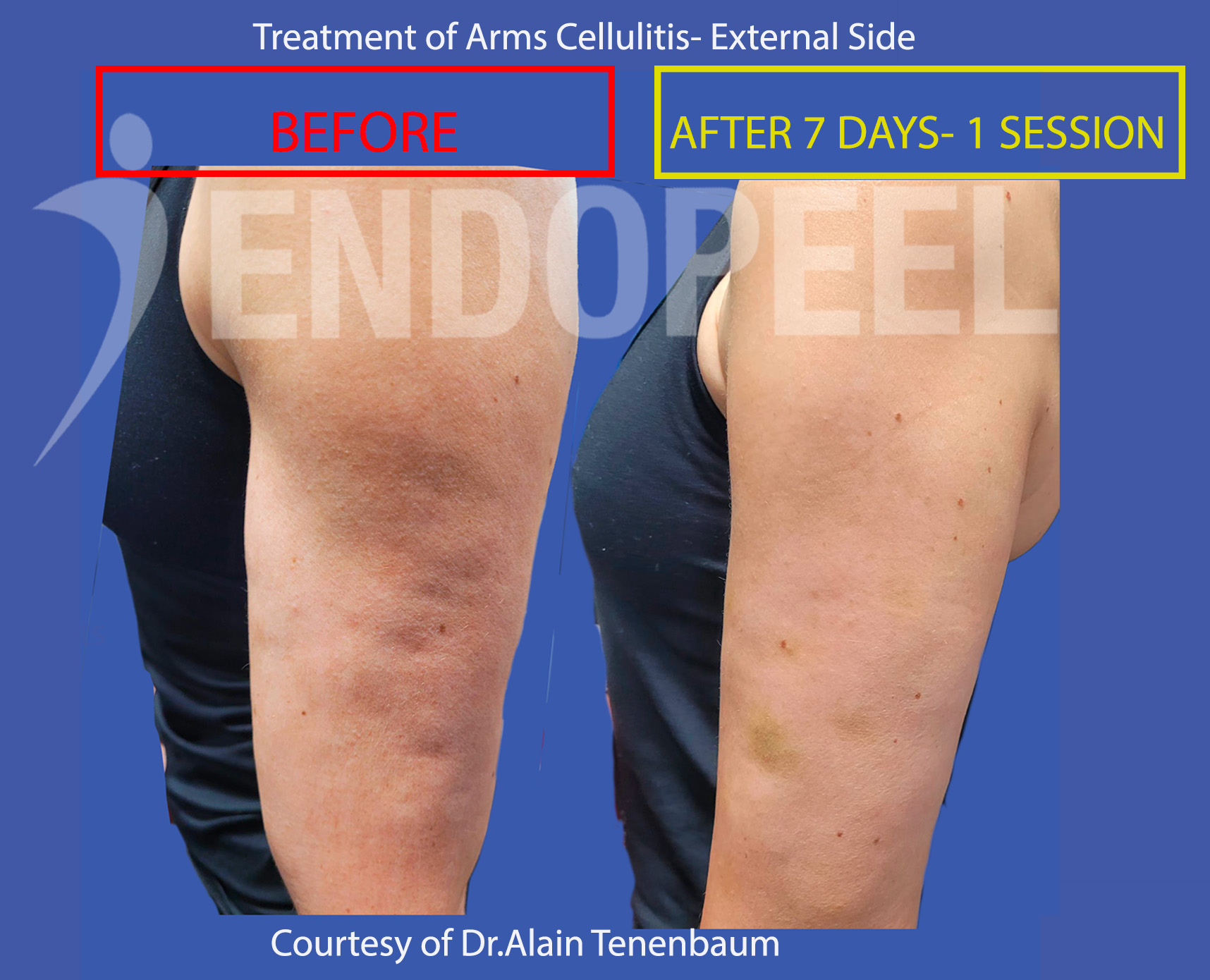 arms-cellulitis